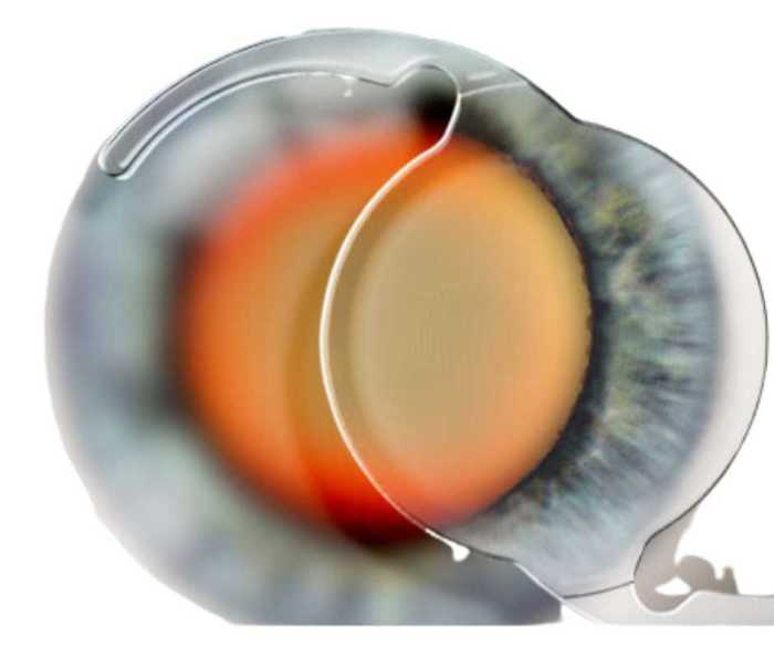 Surgery medicare cataract