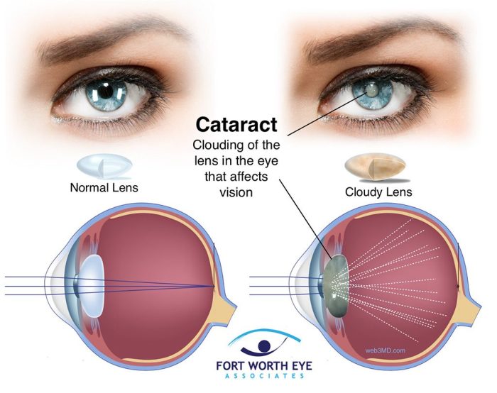 Cataract surgery medicare does cover