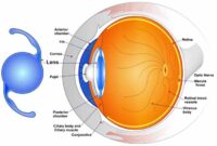 Premium lenses for cataract surgery are not covered by insurance.